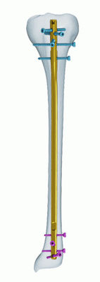 Clou de verrouillage de tibia anatomique titanique de la CE