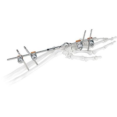 Poignet commun Fixator externe d'implant chirurgical orthopédique médical