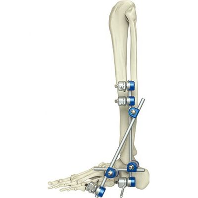 Dispositif de fixation externe de cheville orthopédique médicale d'instrument