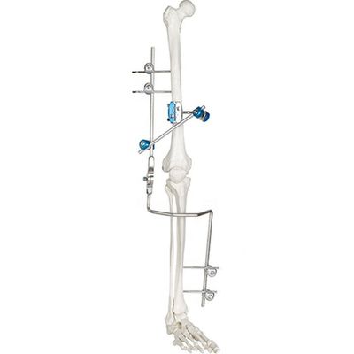 Instruments chirurgicaux orthopédiques externes médicaux de dispositif de fixation d'articulation du genou