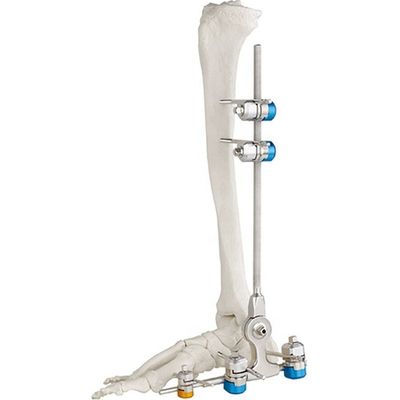 Fracture externe de cheville de dispositif de fixation de marteau médical d'os