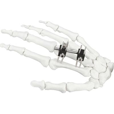 Dispositif chirurgical orthopédique de Mini Fragment Ilizarov External Fixation