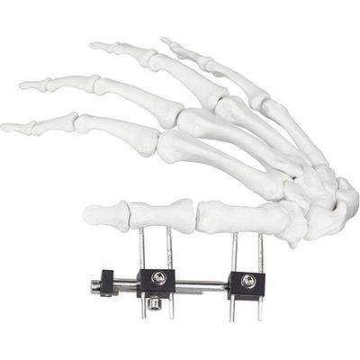 Dispositif chirurgical orthopédique de Mini Fragment Ilizarov External Fixation
