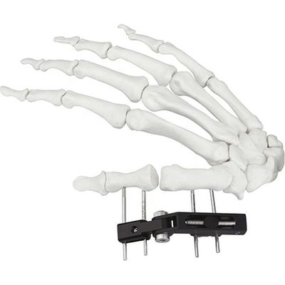 Dispositif chirurgical orthopédique de Mini Fragment Ilizarov External Fixation