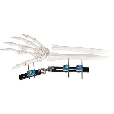 Poignet externe chirurgical orthopédique de dispositif de fixation