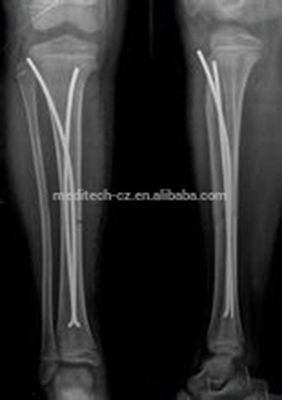 Clou élastique de titane orthopédique des implants DIX pour la chirurgie d'enfants
