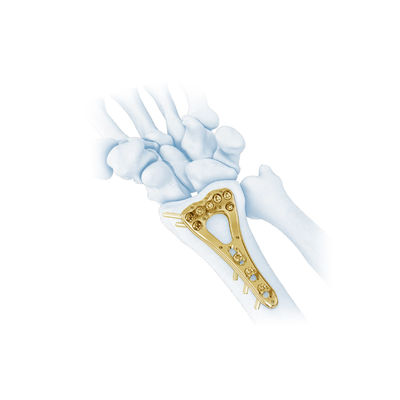Plat distal II de fracture de rayon de paume axiale multi de traumatisme