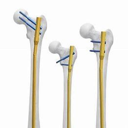 Fémur antibiotique de clou de plat intramédullaire de la CE 11mm
