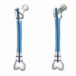 Écurie mécanique de verrouillage de fémur de clou de chirurgie d'alliage de Ti de Precice